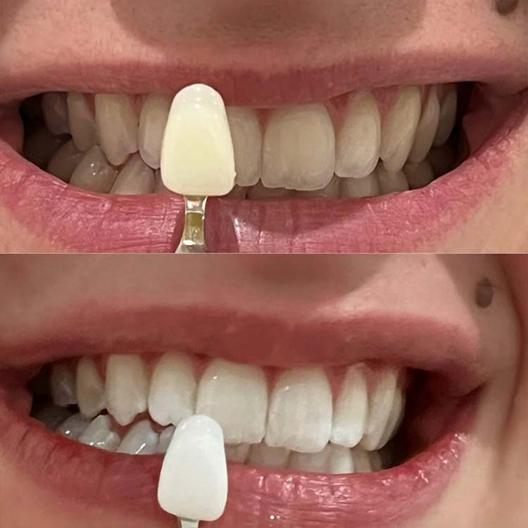 Cosmetic Teeth Whitening Bath